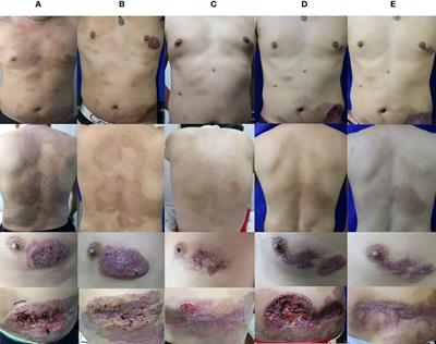 Case report: Severe deep ulcer on the left abdomen mimicking mycosis fungoides caused by Trichophyton tonsurans in a patient with novel CARD9 mutation